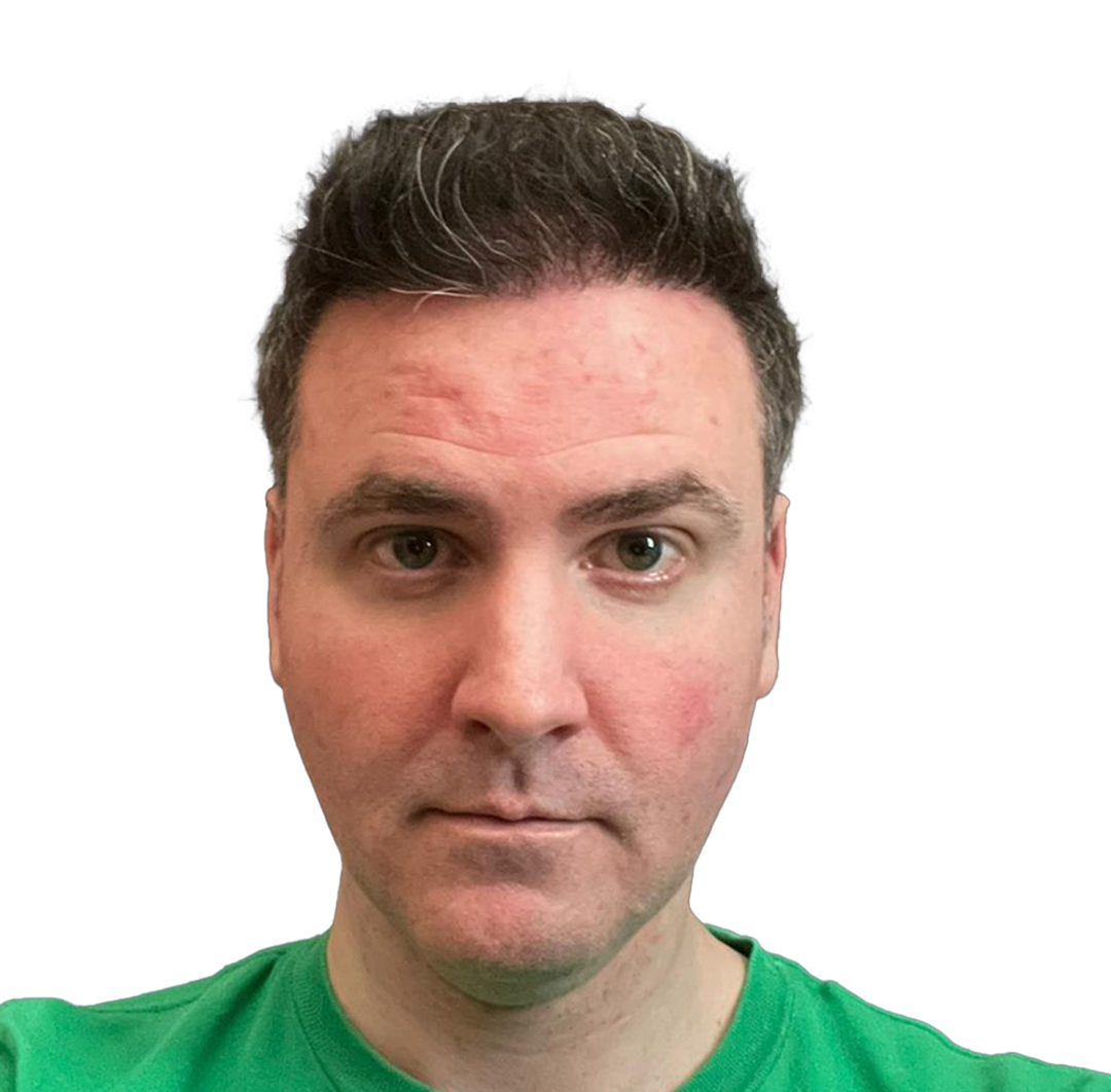 Hair Transplant in Turkey - After Procedure - Customer Photo