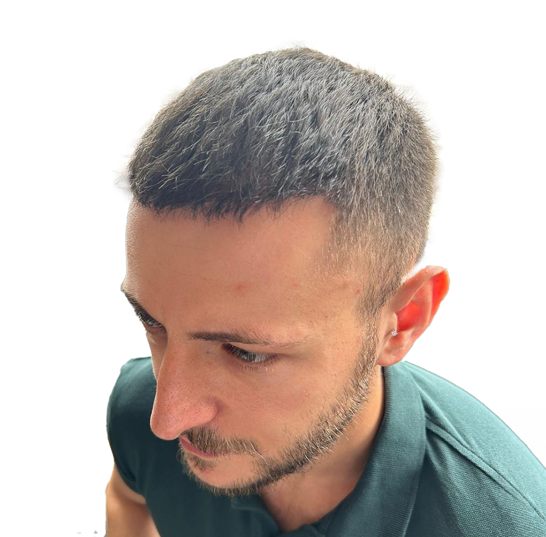 Hair Transplant in Turkey - After Procedure - Customer Photo