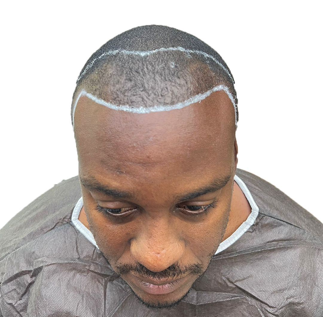 Hair Transplant in Turkey - Before Procedure - Customer Photo