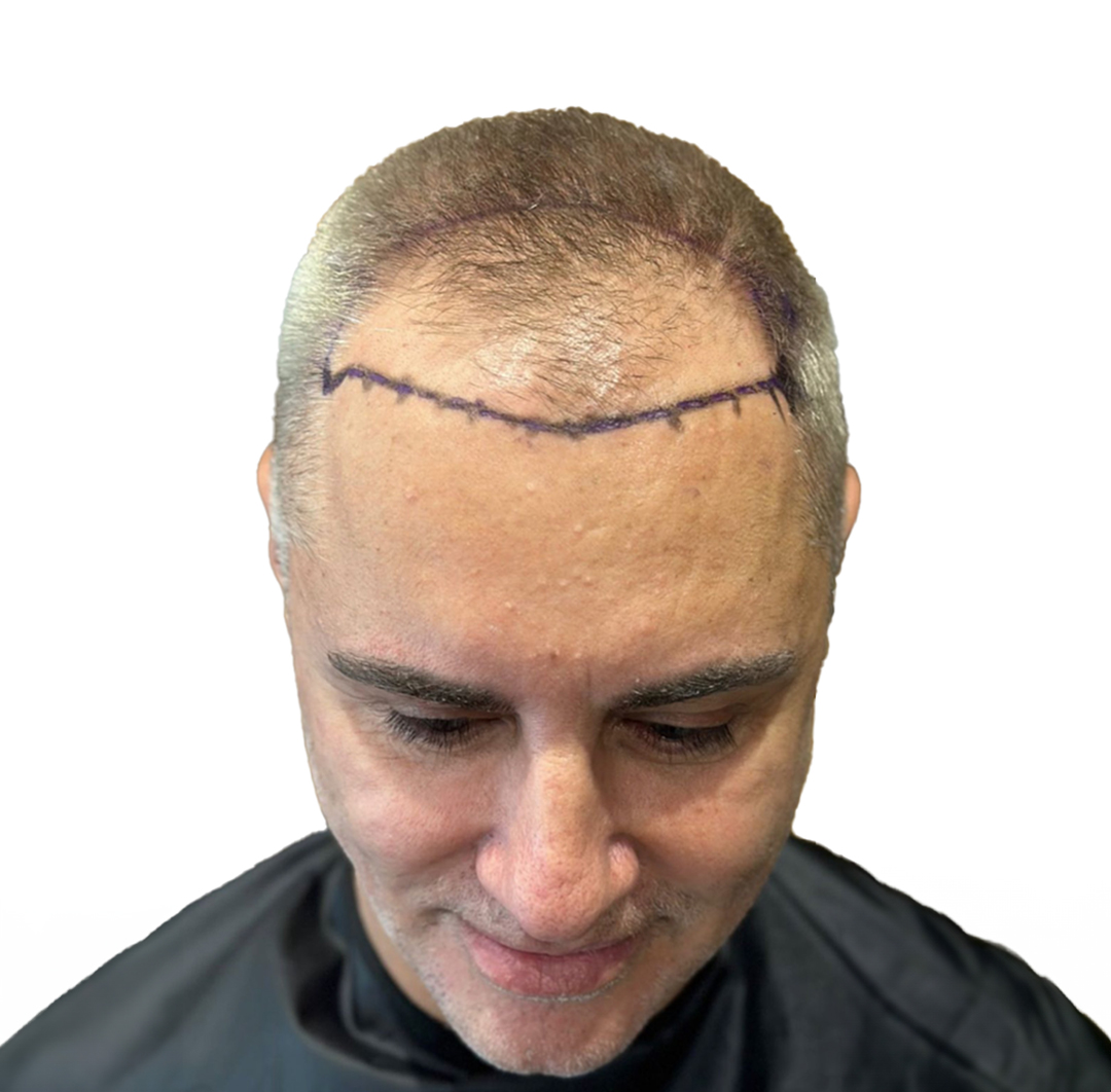 Hair Transplant in Turkey - Before Procedure - Customer Photo