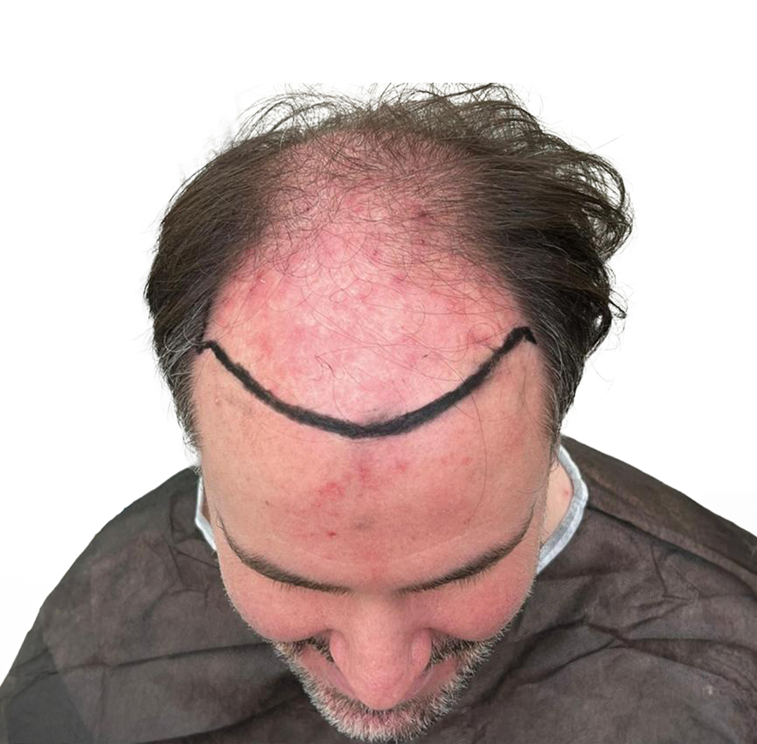 Hair Transplant in Turkey - Before Procedure - Customer Photo