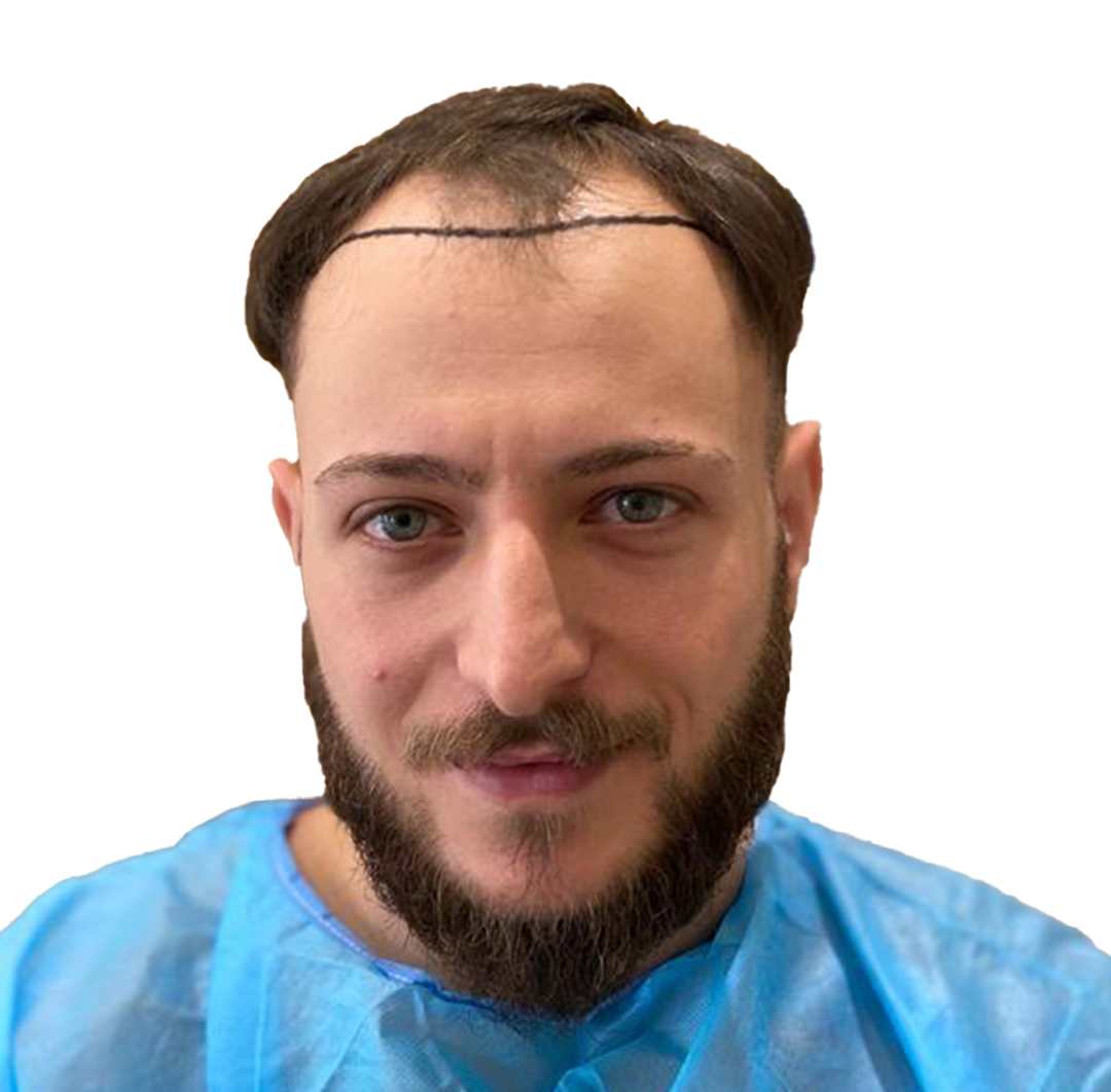 Hair Transplant in Turkey - Before Procedure - Customer Photo