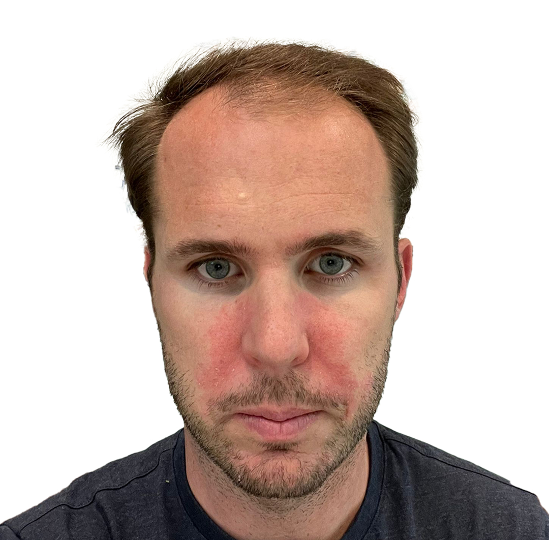 Hair Transplant in Turkey - Before Procedure - Customer Photo